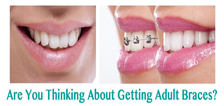 Are You Thinking About Getting Adult Braces in Wisconsin?